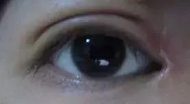 男生割内双眼皮手术,男子去割单眼皮后的结果
