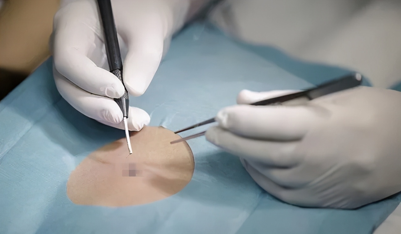 郝医生的治疗效果,全切祛痣一个月的疤痕效果