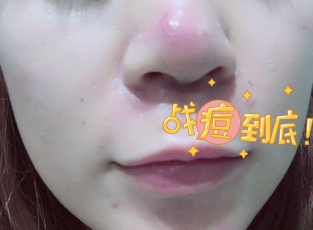 超好用的祛痘膏便宜,有没有好用的祛痘膏推荐女孩子