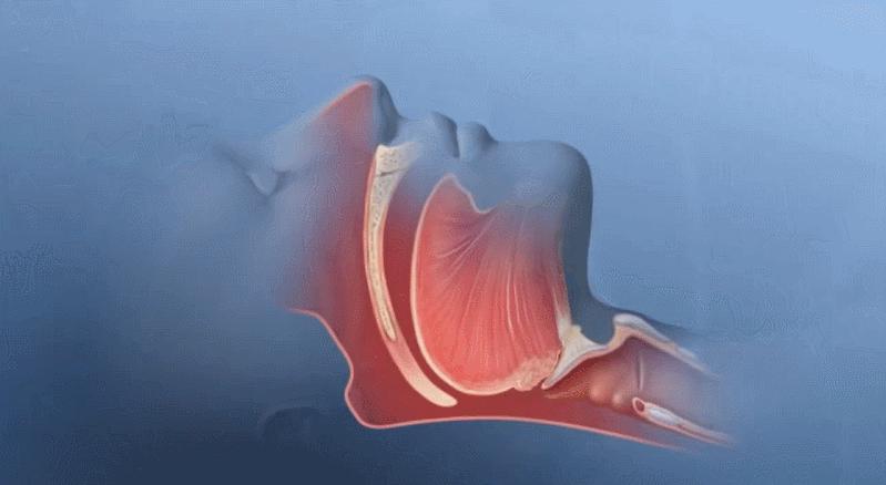 治疗睡眠呼吸暂停症用哪种呼吸机,双水平睡眠呼吸机的作用