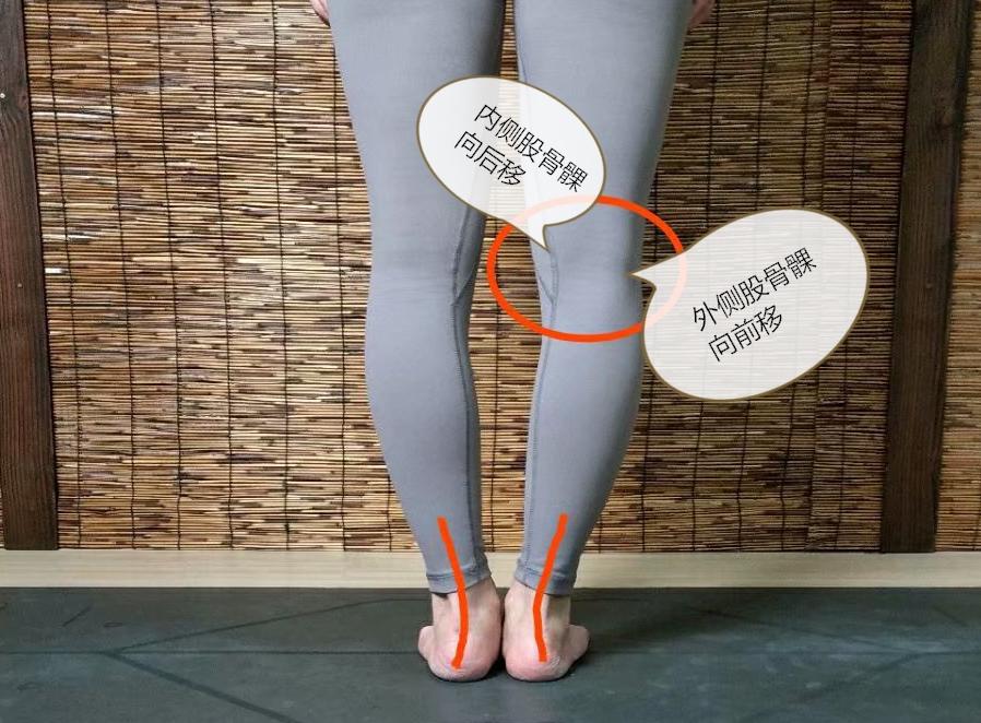 小腿外侧粗改善动作,小腿外扩和小腿外翻用什么矫正