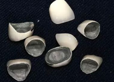 一个月工资种牙,一年工资不够种牙