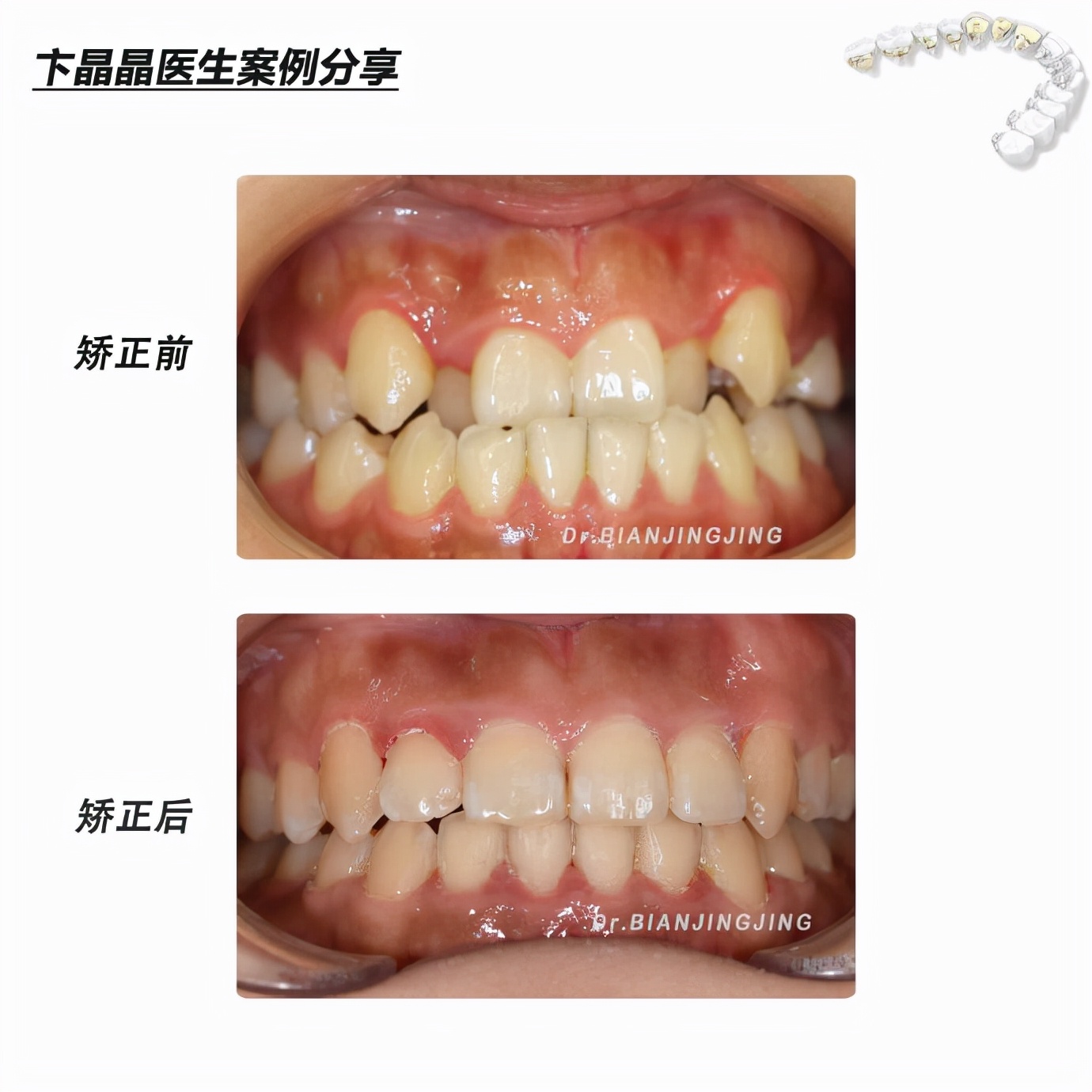 沈阳矫正牙齿大概多久能矫正过来,沈阳牙齿代偿矫正哪里好