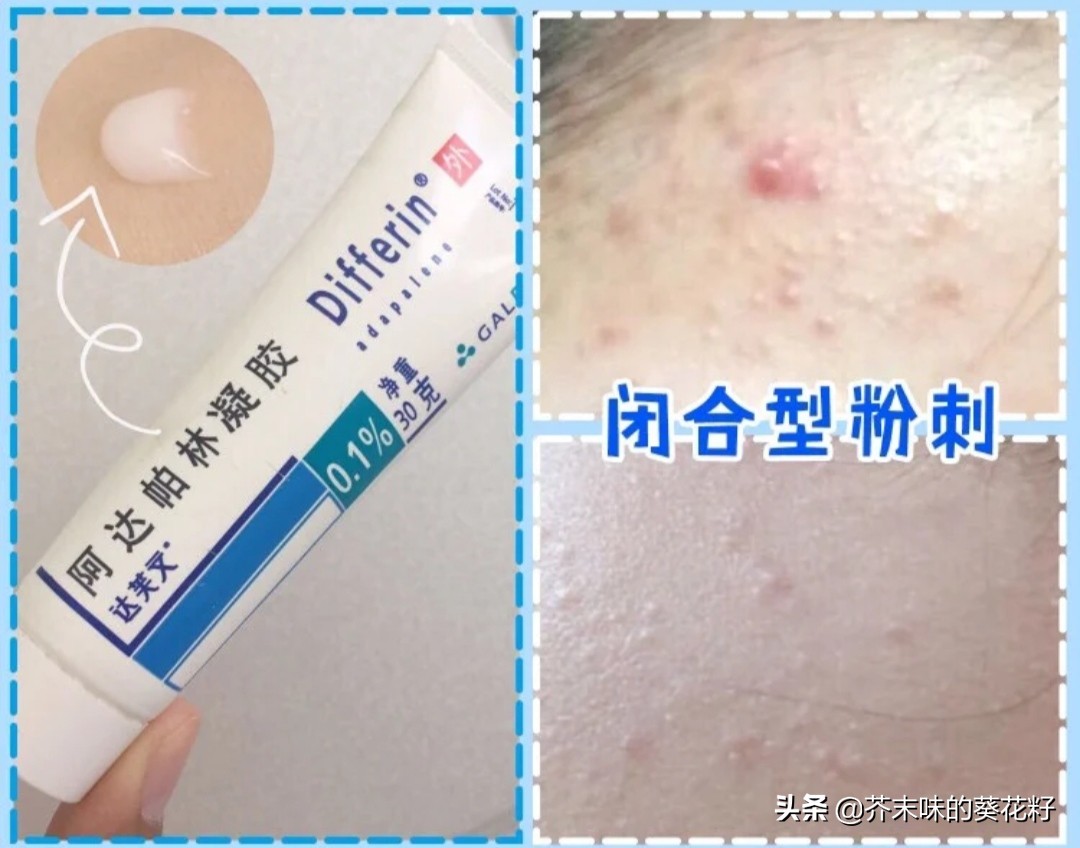 不同部位痘痘消除方法小学生,不同类型的痘痘的祛痘方法