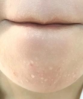 这6种办法能助你快速去闭口,去闭口最简单的消除方法