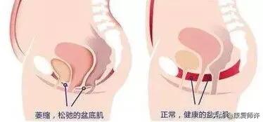 产后腹直肌分离恢复瘦肚子训练,产后腹直肌分离恢复的最佳方法