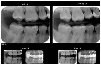 小孩拍牙齿片有危害吗,拍牙片对孩子的影响