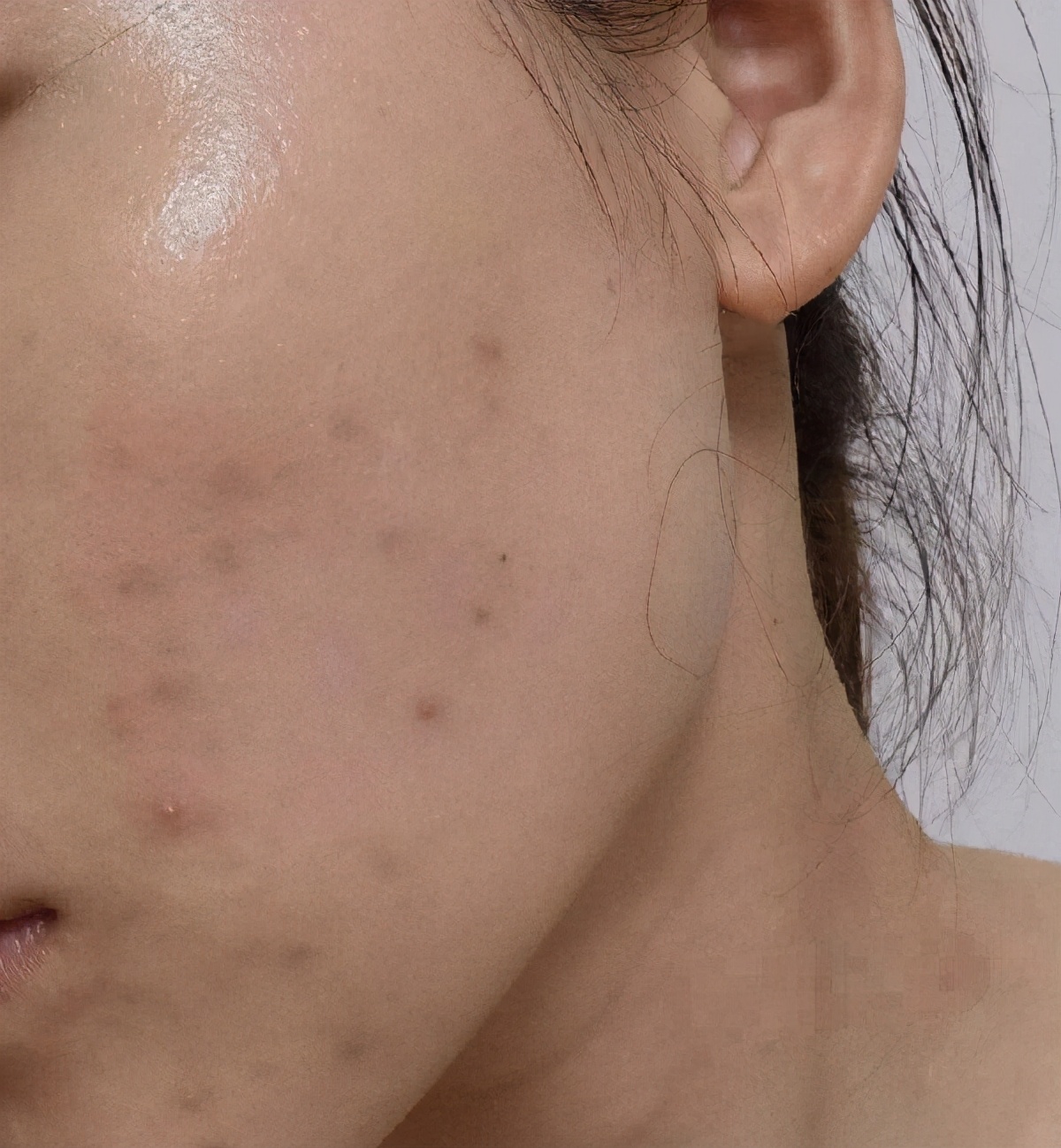 教你4个淡化黑色痘印的有效方法,改善痘印用什么酸效果最好