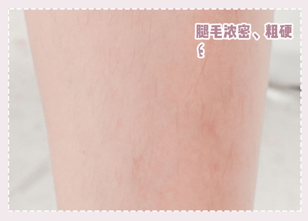 体毛脱毛的效果怎么样,天生体毛旺盛的人正常吗