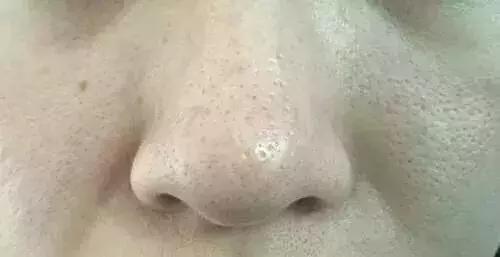 油脂型毛孔粗大怎么护理,毛孔粗大油光满面日常该如何清洁