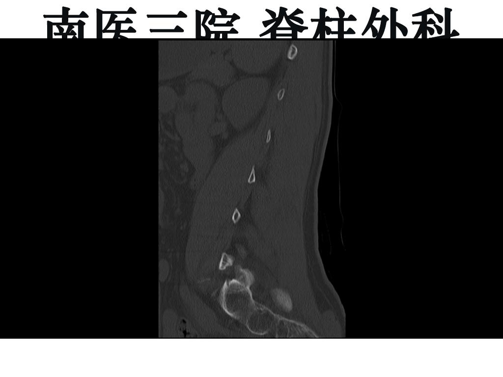 峡部裂导致的滑脱是不是必须手术,峡部裂保守治疗的方式有哪些
