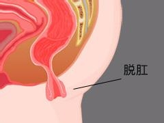 肛门里有“一坨肉”脱出来了。