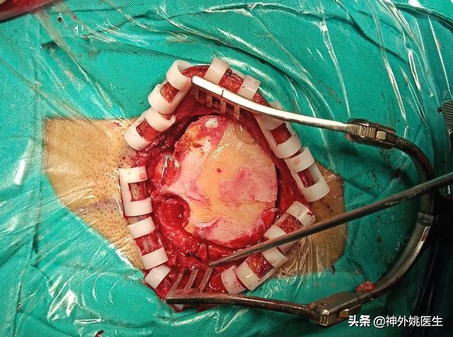 球囊扩张血肿怎么办,经皮穿刺脑血管腔内球囊成形术