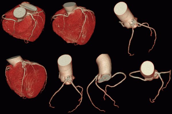 增强ct结果血管狭窄95%要做支架吗,50岁ct检查出冠脉钙化斑严重吗