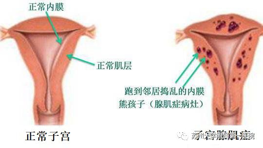 为什么只是痛经，医生却让我上环？