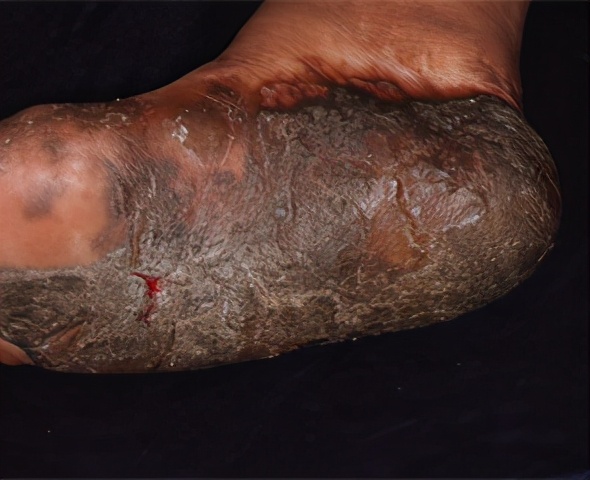 老年人脚底皮肤皲裂症原因是什么,更年期脚后跟皲裂是怎么回事