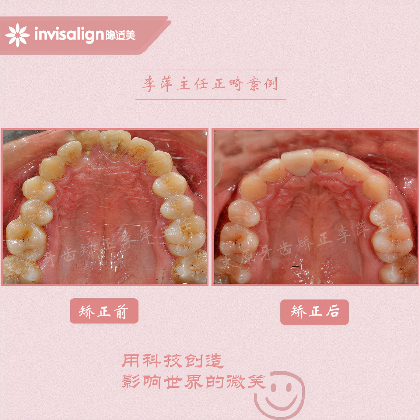 重度牙齿拥挤矫正经历,太原矫正牙齿需要多久