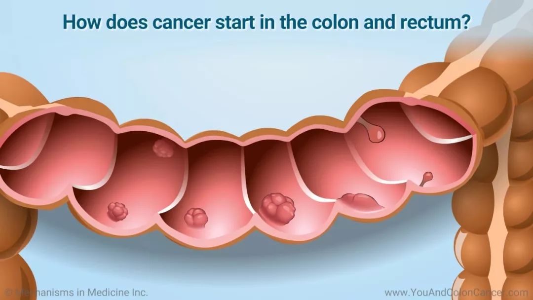 结肠癌入侵淋巴,结肠癌最佳终结者