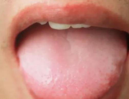 又上火了怎么回复,急火上火