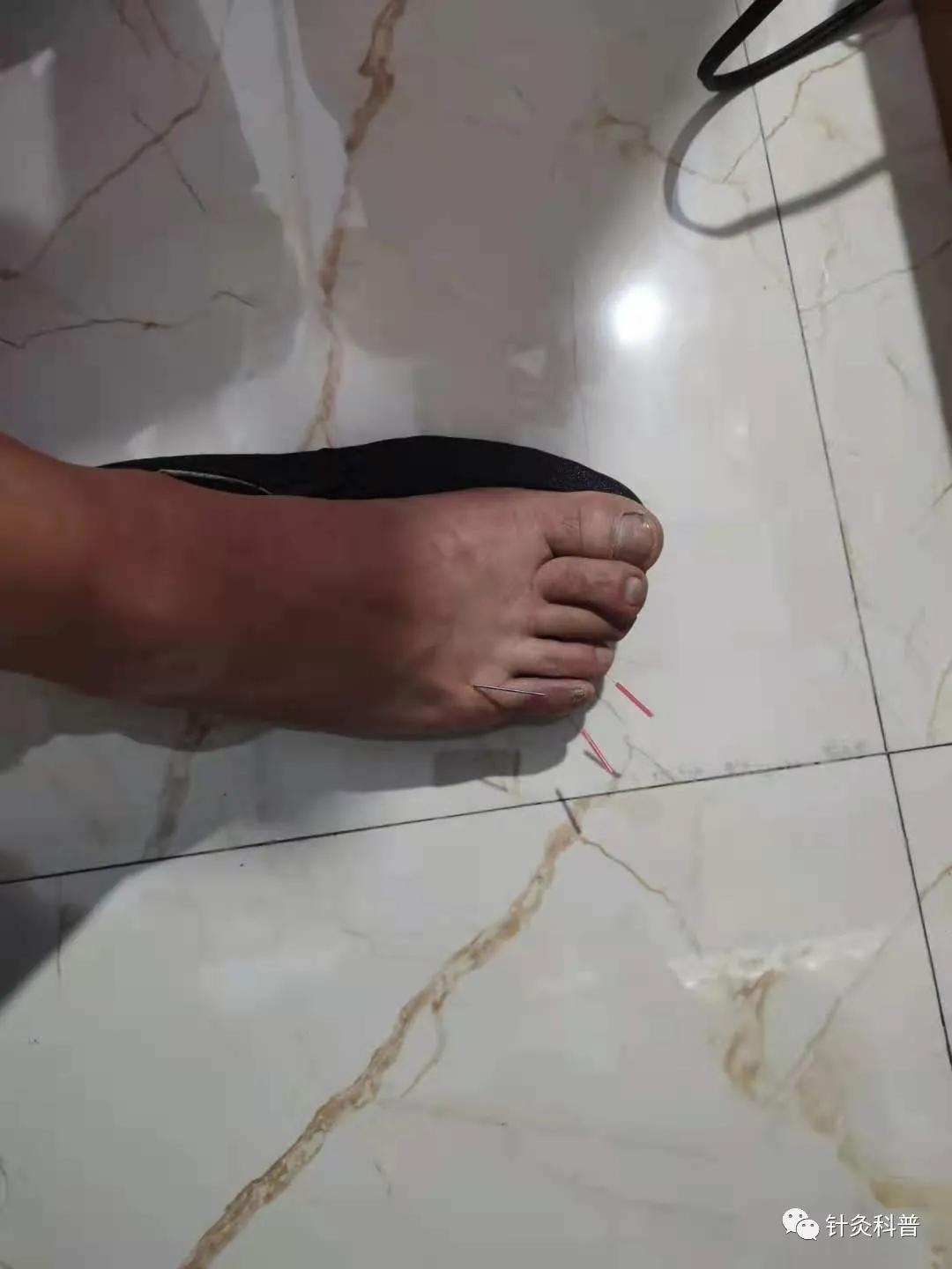 民间中医针灸治疗疑难杂症,中医疑难杂症针灸治疗成功