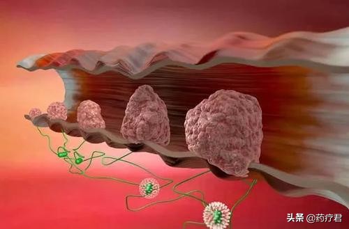 身体出现5种表现警惕肠癌出现,出现粘液脓血便的最常见病因