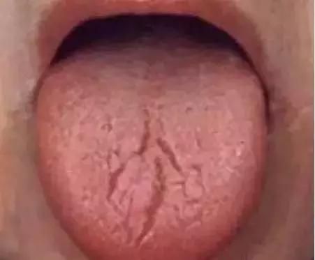 舌头一旦出现这个信号马上找中医,舌头一旦出现这个信号马上去医院