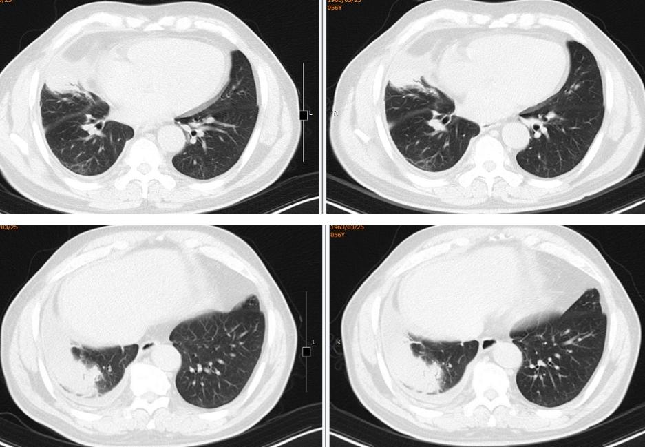 56岁男性发现双肺,56岁男性发现双肺数百个结节