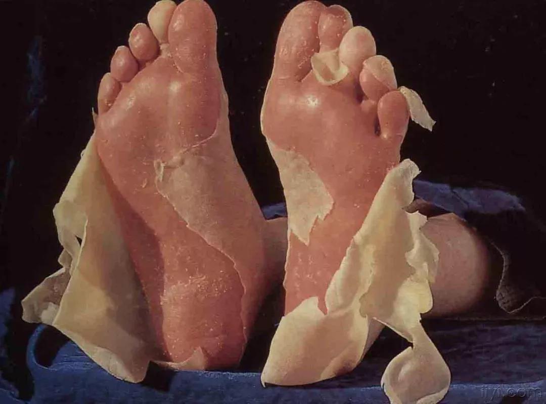 免疫治疗不良反应及处理方法,免疫治疗不良反应的处理