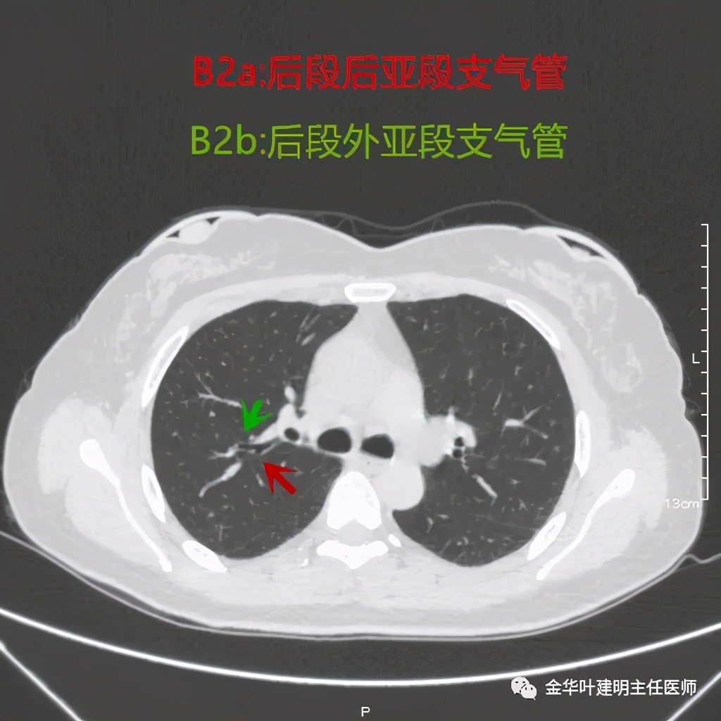 左肺上叶在ct影像上怎么看,平扫ct可以看出肺肿瘤的变化吗
