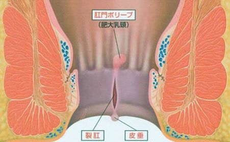 便血找不出原因,便血的疑惑到底是什么