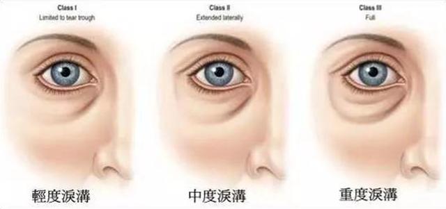 关于泪沟告诉你三个绝招,新手好上手的遮泪沟方法