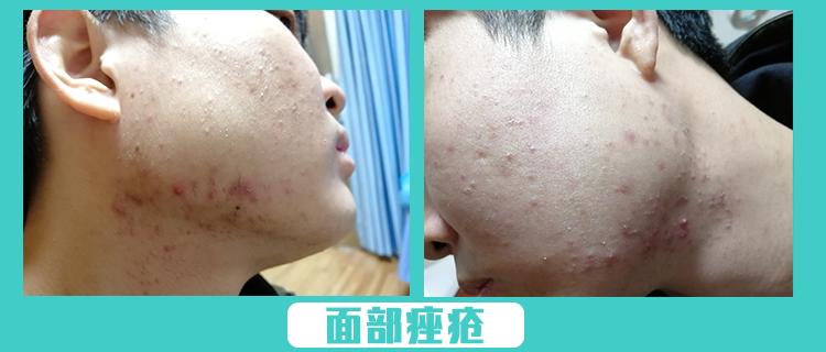 疮疡真的很难治疗吗,疮疡如何正确治疗