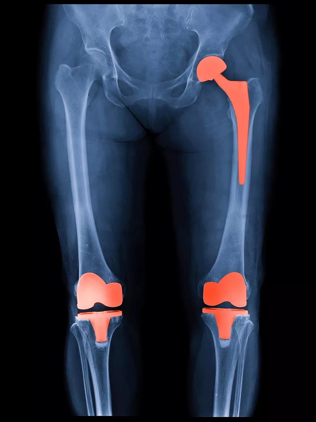 膝盖疼、老寒腿、长骨刺，关节炎了怎么办？45个短问，彻底讲清