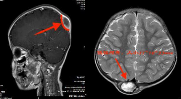 小孩头上长肿块是良性还是恶性,女童头上有个小疙瘩像疣