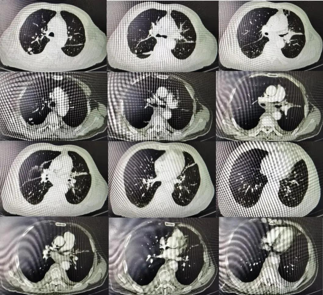 咳嗽咳痰胸腔积液10月余治疗无效，艰难追踪得出哪些教训？（上）