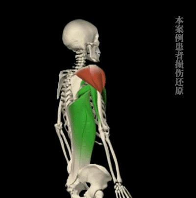 脊柱侧弯治好了，为什么患者反而治坏了？内附髋关节平衡松动法