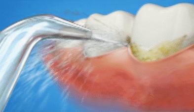 每年洗一次牙对牙齿有伤害吗,洗一次牙大概多少钱左右