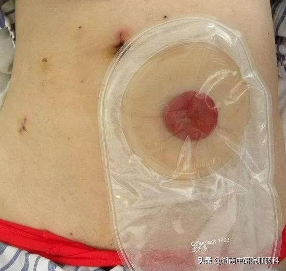 造口患者日常生活护理宣教,造口病人夏季护理