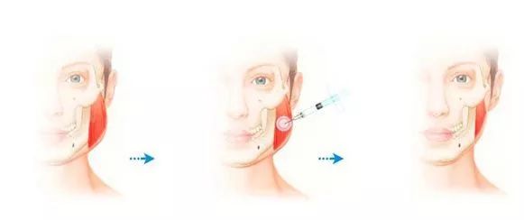 明明没动刀,为什么脸还是越来越精致?