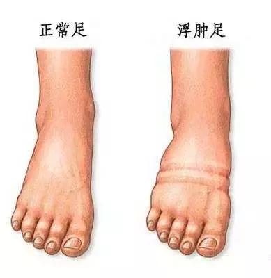 肿眼泡什么引起的,肿眼泡是什么病的前兆