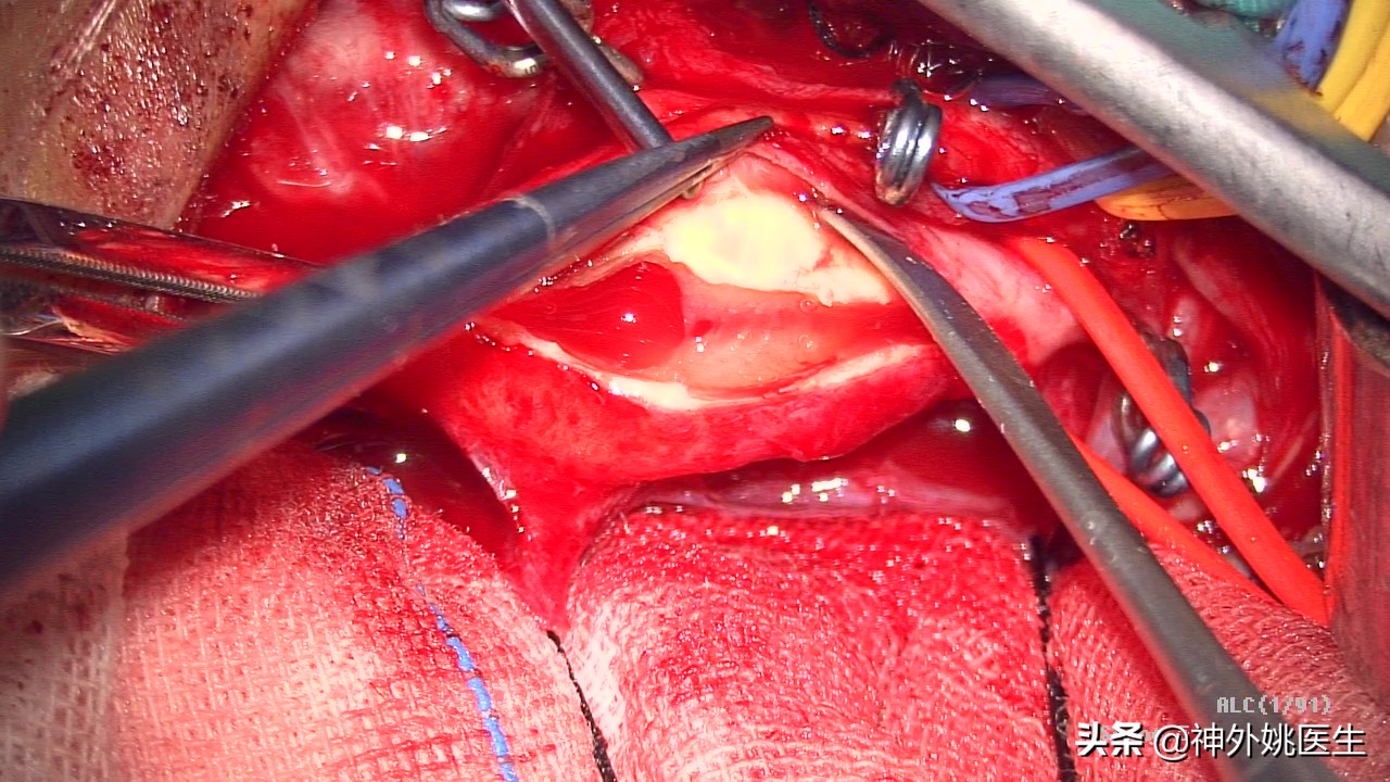 颈动脉狭窄的外科治疗