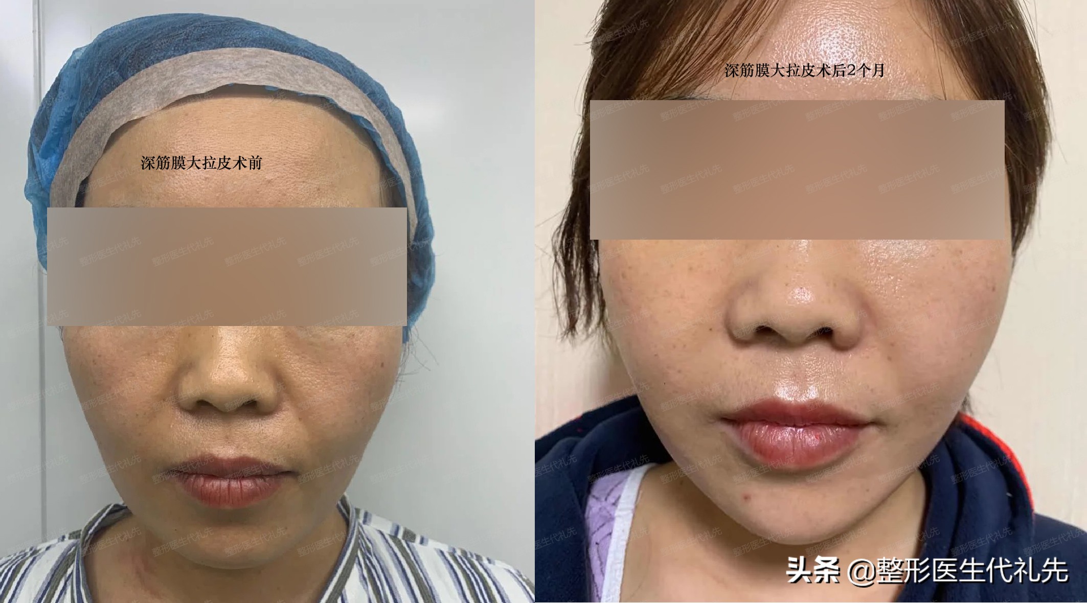 法令纹怎么改善三个方法学起来,有没有特别好的淡化法令纹的方法