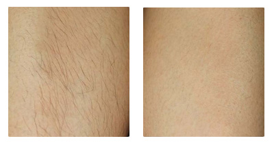 皮肤黑对脱毛效果有影响吗,脱毛后皮肤很黑怎么办