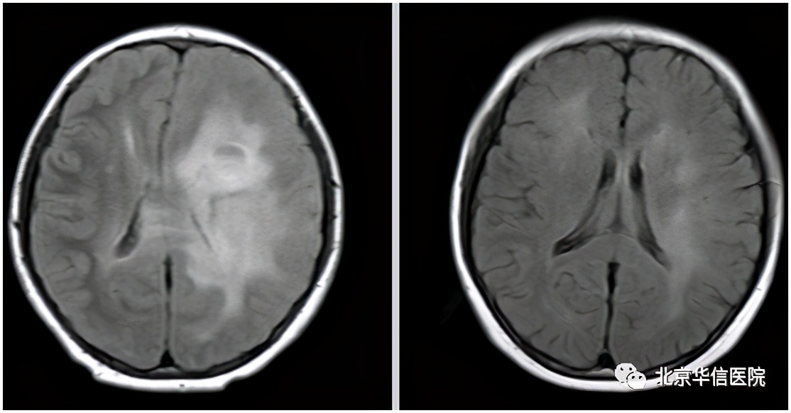清华大学第一附属医院治疗癌症,清华一附院放疗