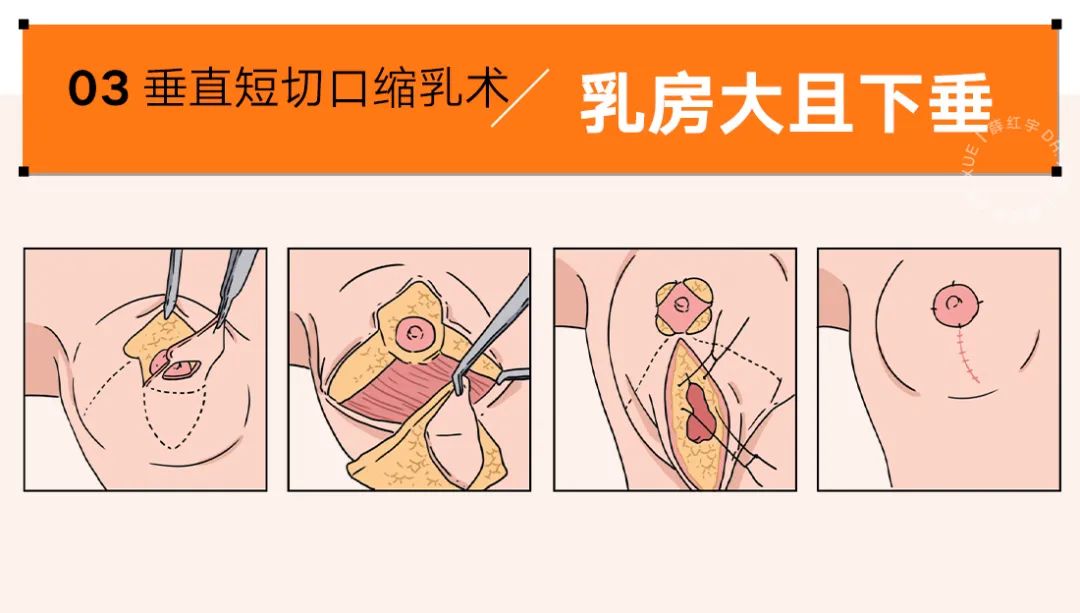 乳房缩小常见术式,乳房缩小术解除乳房过大的烦恼