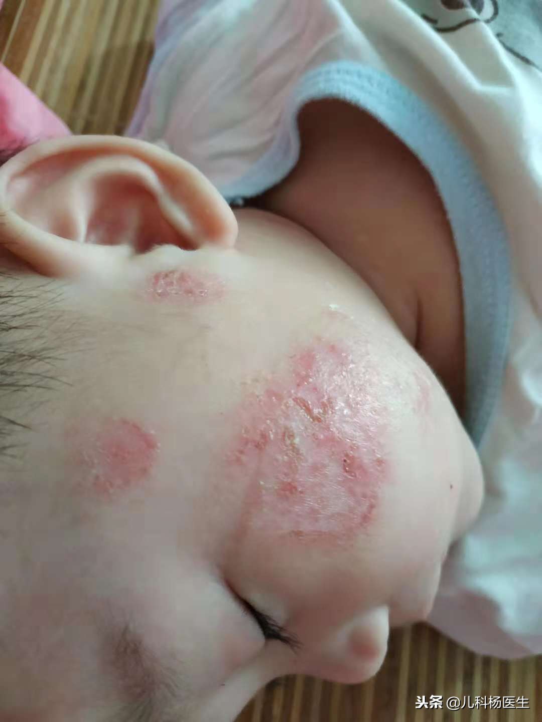 宝宝湿疹涂了炉甘石又严重了,宝宝湿疹抹了药更严重了