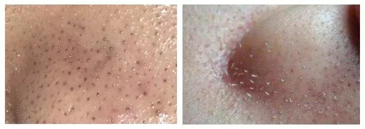 黑头闻起来很臭,黑头很痛怎么回事