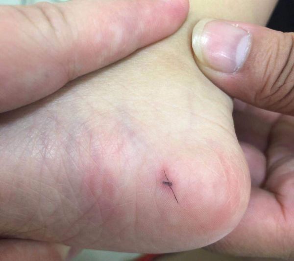 宝宝脚底长虫子,脚底有黑虫