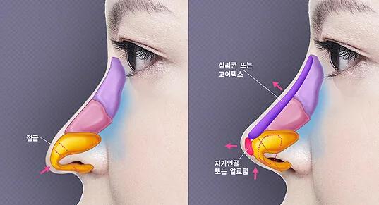 鹰钩鼻与哪种鼻子很相似,箭头鼻和悬胆鼻