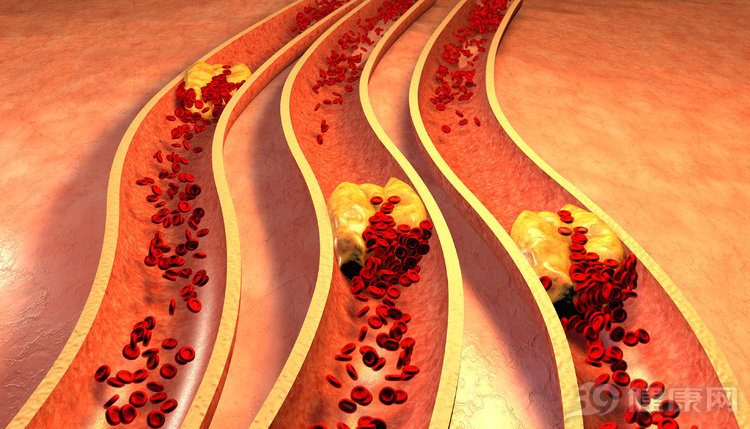 主动脉夹层会造成怎样的严重后果,主动脉夹层为什么在我国是常见病